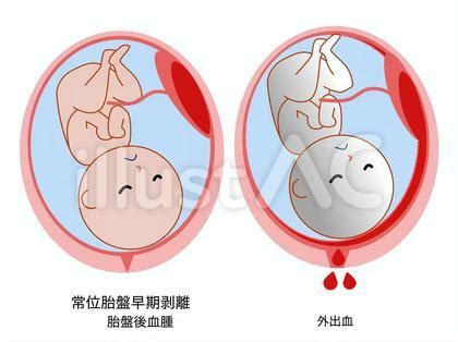 胎盤剝離後期|常位胎盤早期剥離とは？なりやすい人の特徴・予防法。